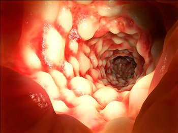 Ulcerative Colitis